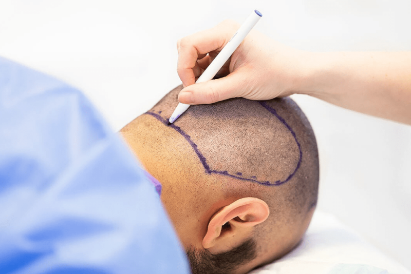 donor area for hair transplant 