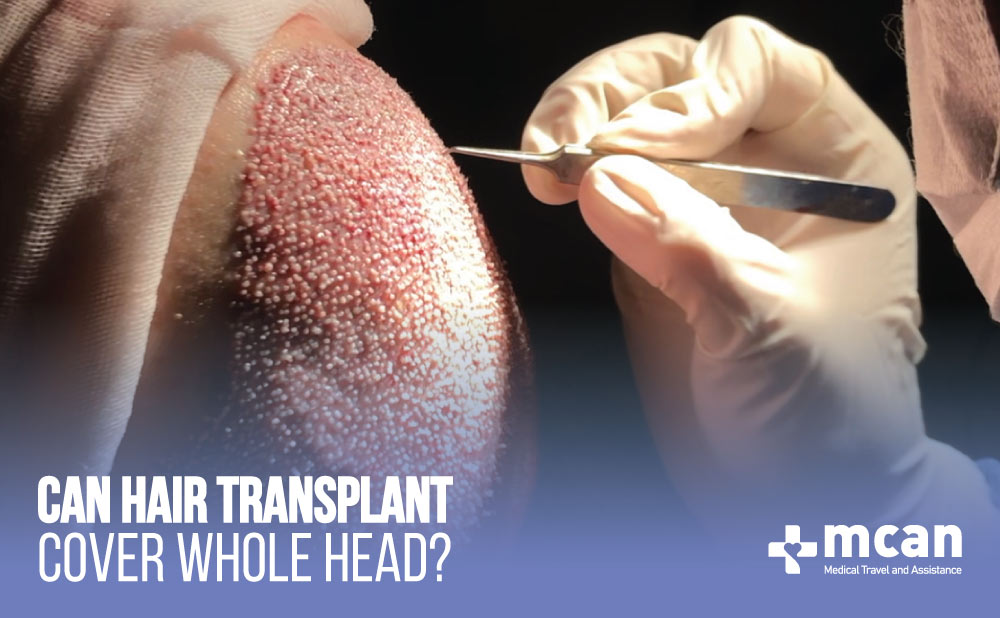 Can Hair Transplant Cover Whole Head?