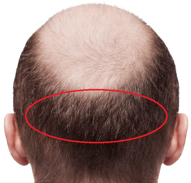 Donor area for full head hair transplant