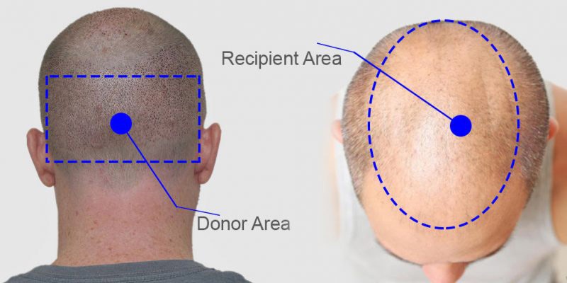 the donor and recipient areas for whole head hair transplant