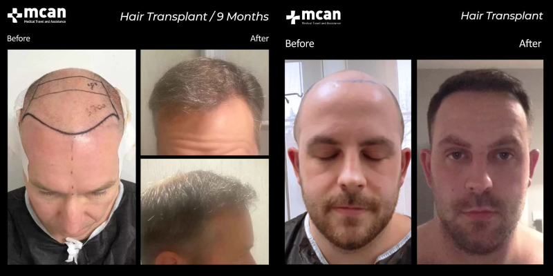 hair transplant entire head with Mcan Health before and after 