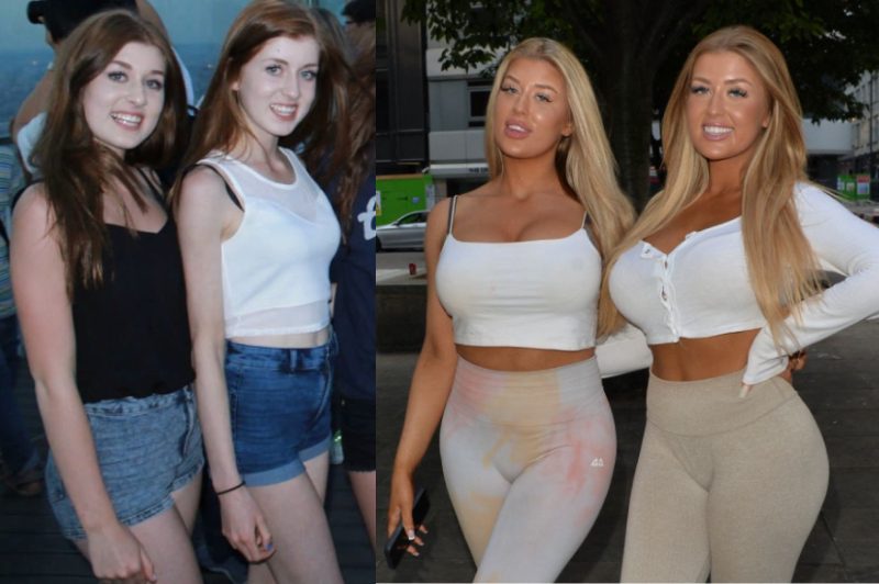 Jess and Eve Gale Before Plastic Surgery and After 
