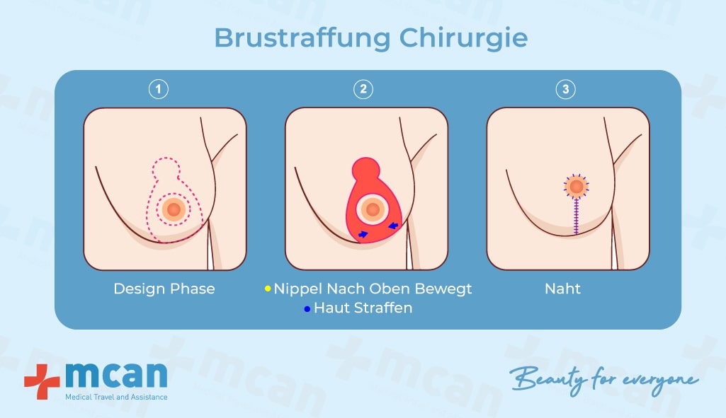 Bruststraffung Turkei Brust Op Kosten Und Erfahrungen Mcan Health