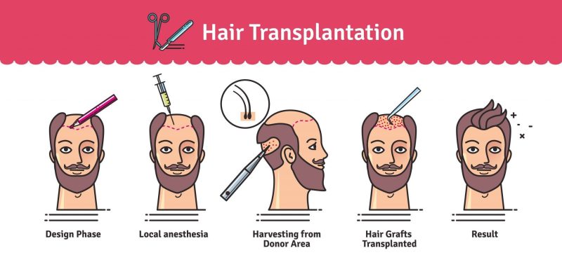 Hair transplant stages from designing to implanting 