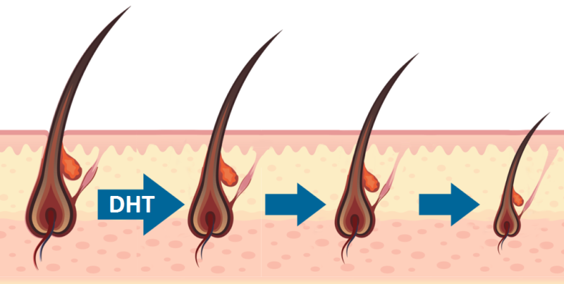 DHT hormone affect on hair follicles 