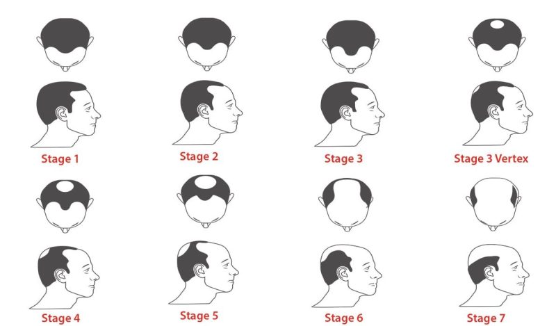 Norwood Hamilton hair loss stages 