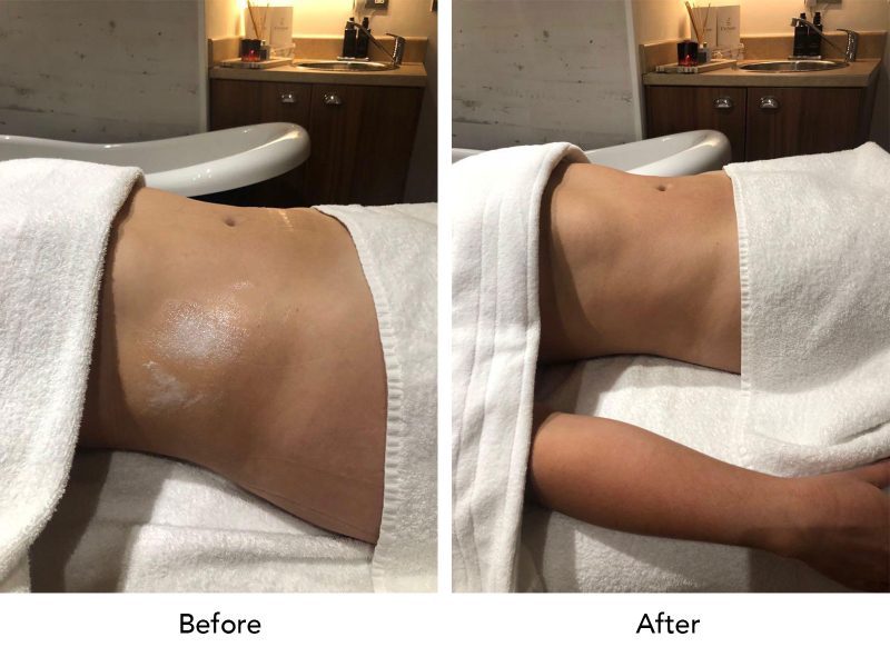 lymphatic drainage massage before after
