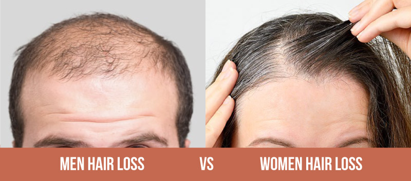 Balding and Hair Thinning, What Are the Best Hair Loss Treatments 3 Men Hair Loss vs Women Hair Loss Does Hair Loss Only Happen to Men?