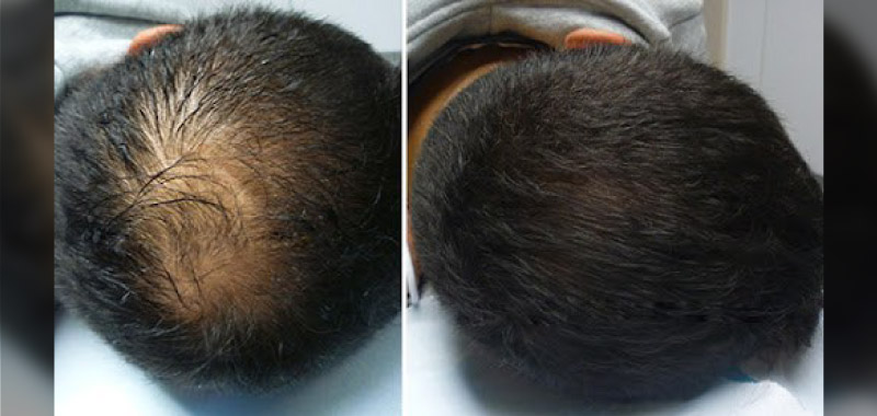 micropigmentation is a cosmetic hair treatment 
