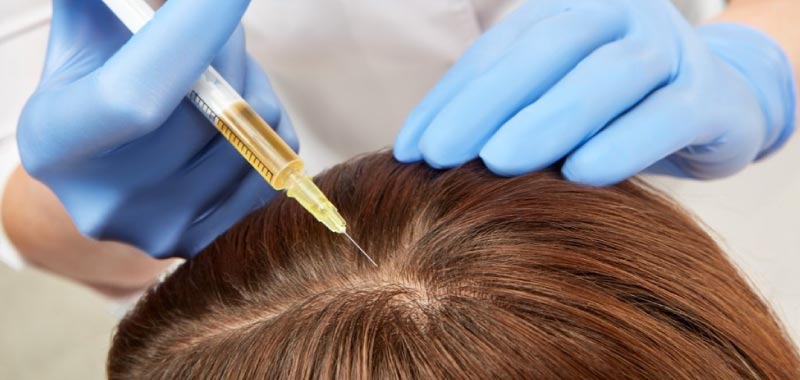 PRP hair restoration methods