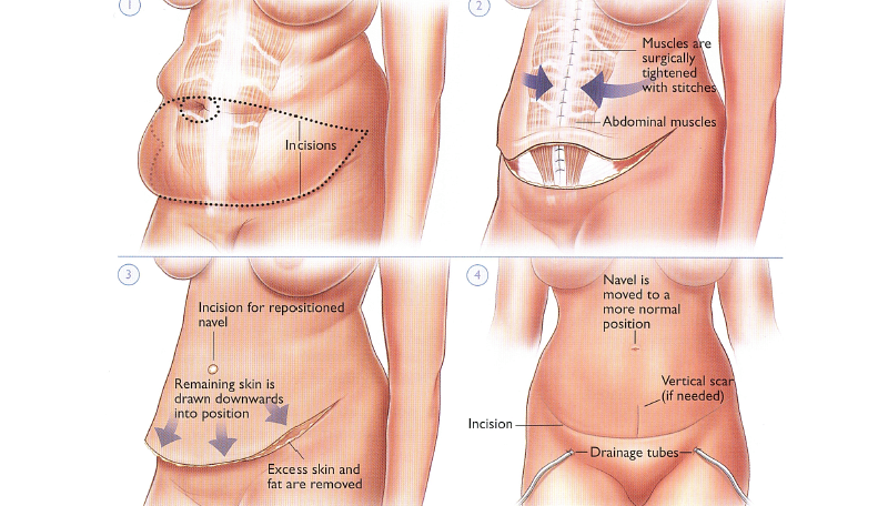 Tummy tuck process, before and after