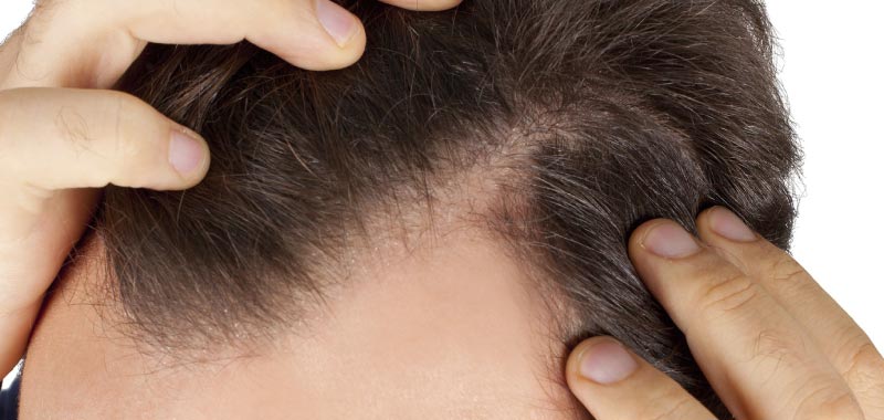 Receding Hair line and hair loss 