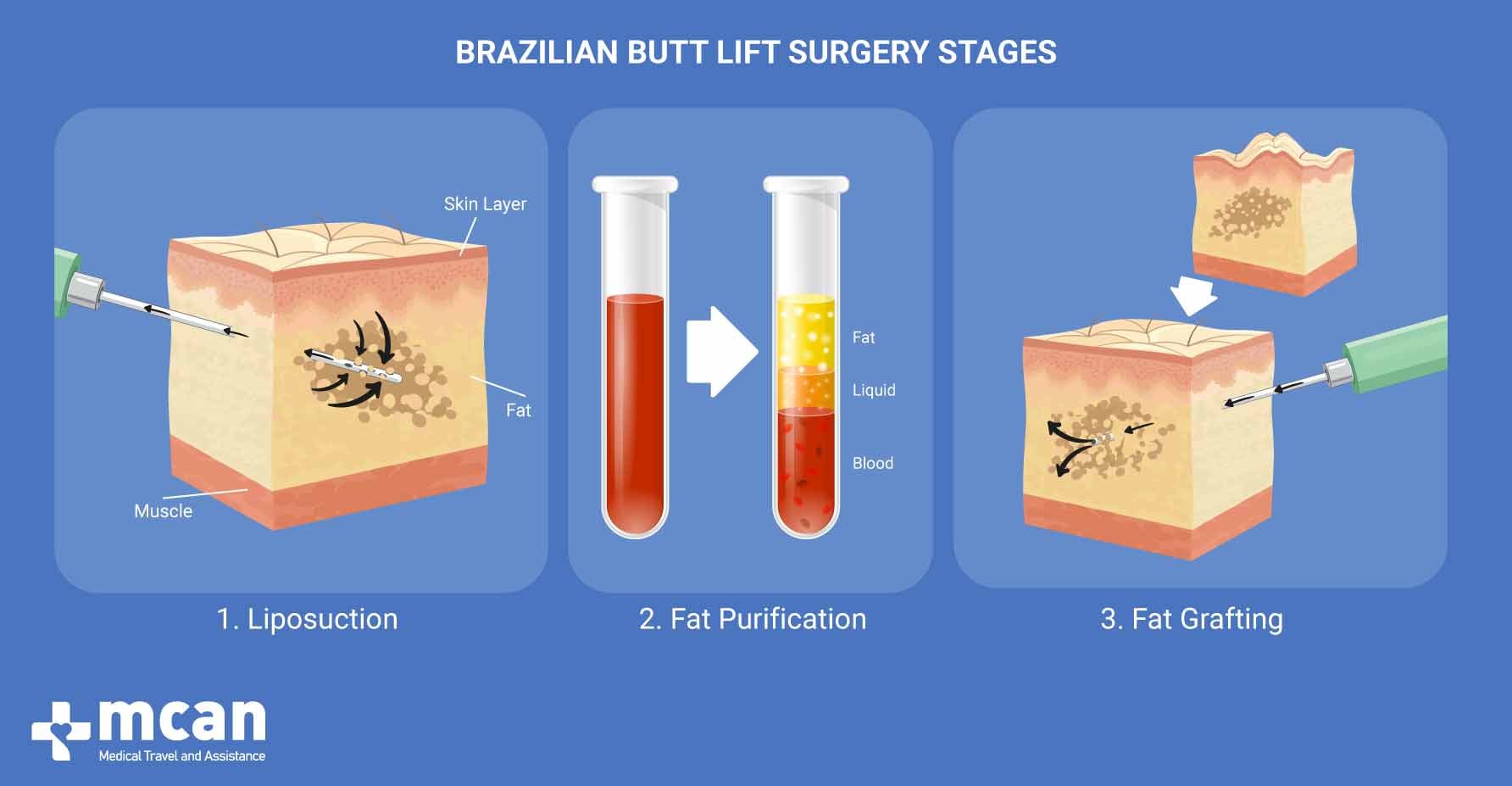 BBL is fat transfer from the stomach to the buttocks