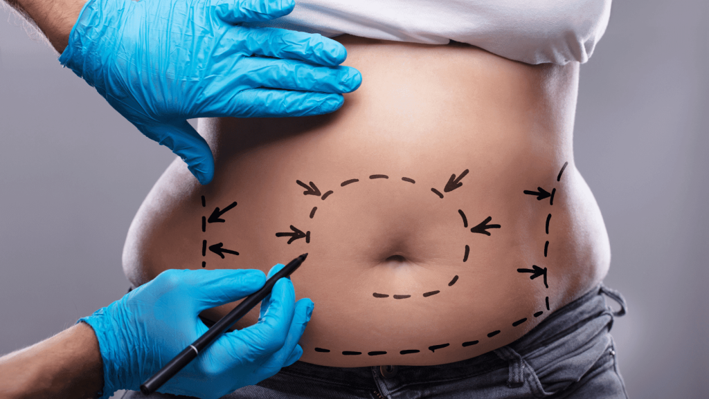 Cirugía bariátrica o liposucción: ¿qué me conviene? | MCAN Health