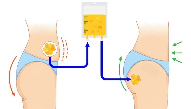 BBL Survival is fat transfer from tummy to buttocks