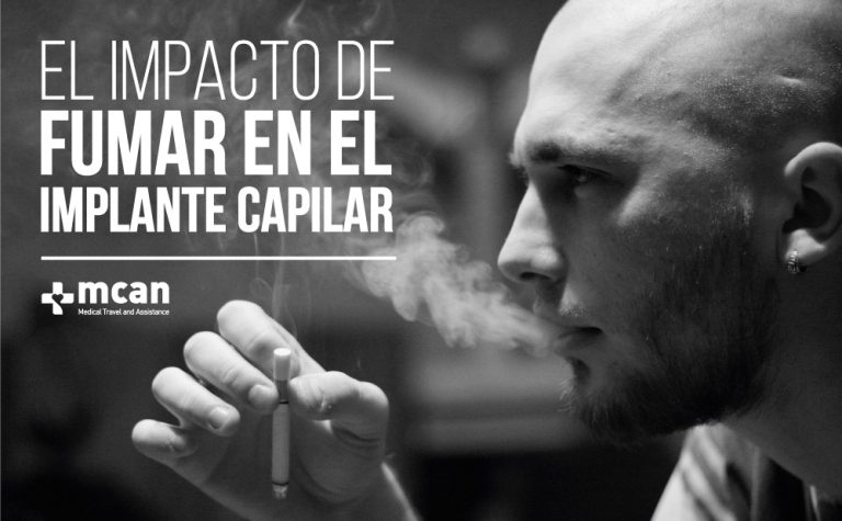 El Impacto de Fumar en el Implante Capilar 2 el impacto de fumar en el implante capilar Fumar y trasplante capilar: por qué no hacerlo | MCAN Health Blog