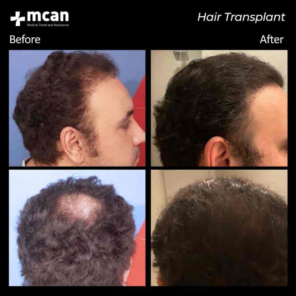 Hair Transplantation Before and After MCAN Health
