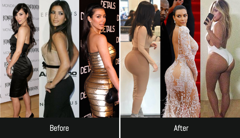 Kim Kardashian BBl Removal