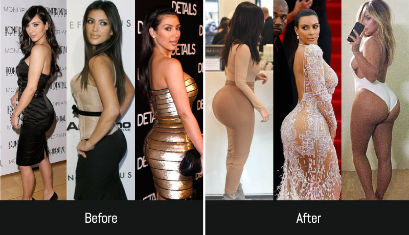 Keeping Up With The Kardashians Part I: Kim Kardashian Plastic Surgery Journey 15 kim kardashian bbl removal Kim Kardashian BBl Removal