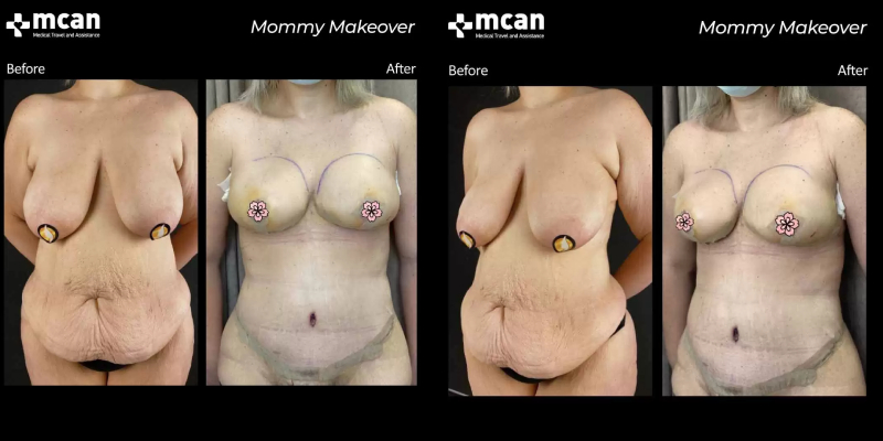 Mommy makeover with Mcan Health 
