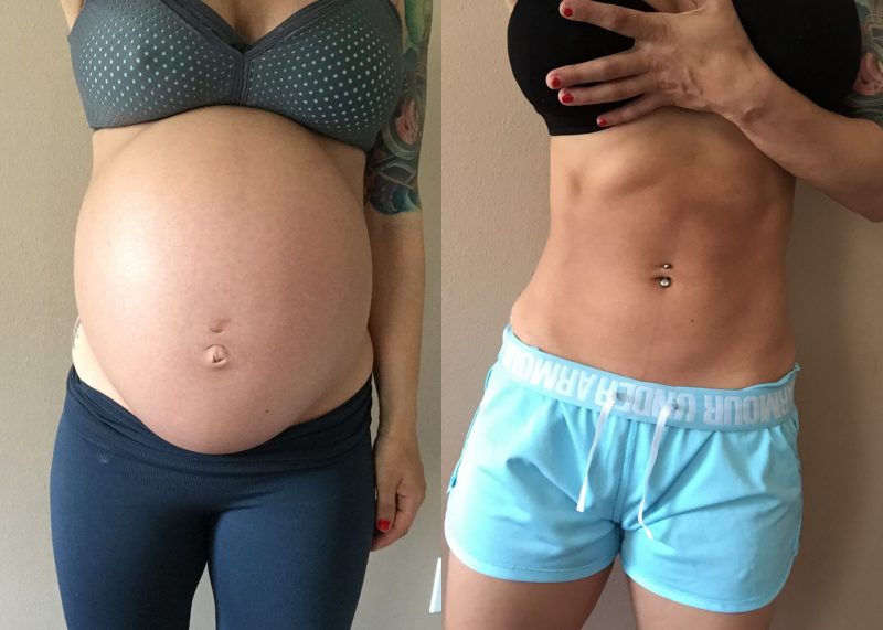 Tummy Tuck After Pregnancy