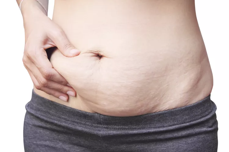 liposuction and tummy tuck after pregnancy 