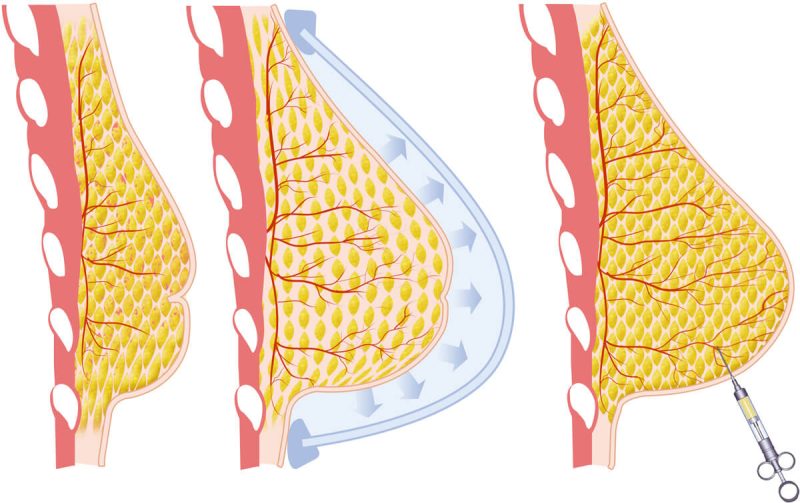 at grafting breast reconstruction