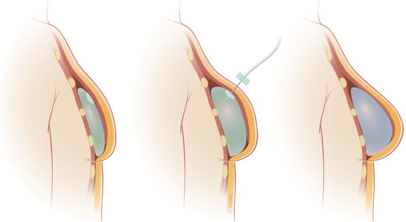 breast augmentation with saline 