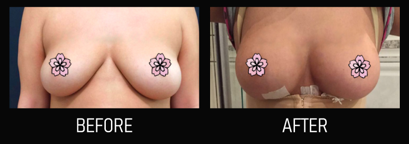 fat transfer breast augmentation before and after