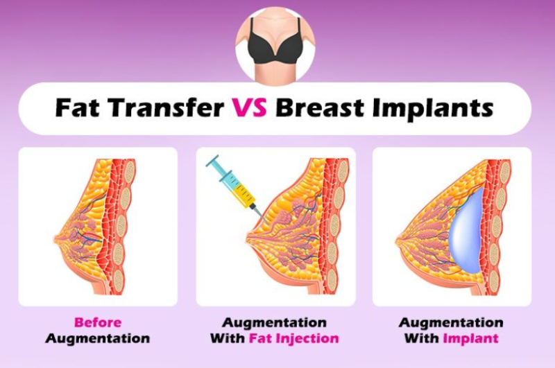 fat transfer vs breast implants 