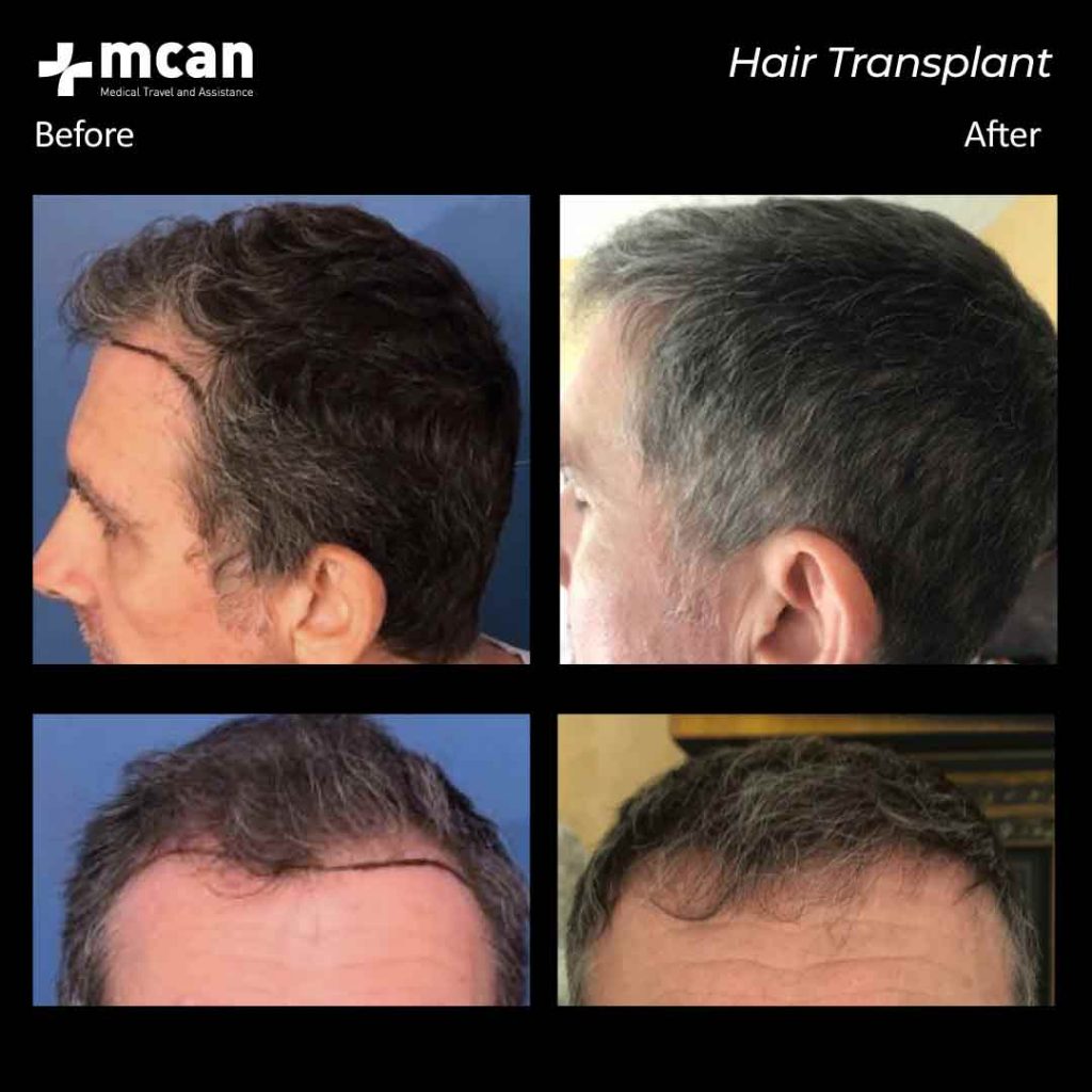 Hair Transplantation Before and After MCAN Health