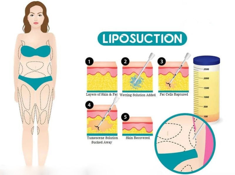liposuction steps 