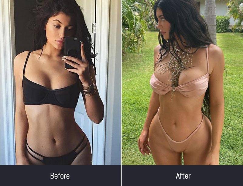 kylie jenner before and after plastic surgery Kylie Jenner Body surgery