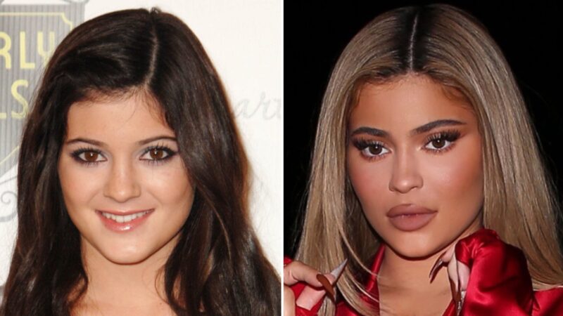 Kylie Jenner Before and After Lip Comparison