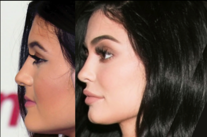 Kylie Jenner Chin Reduction 