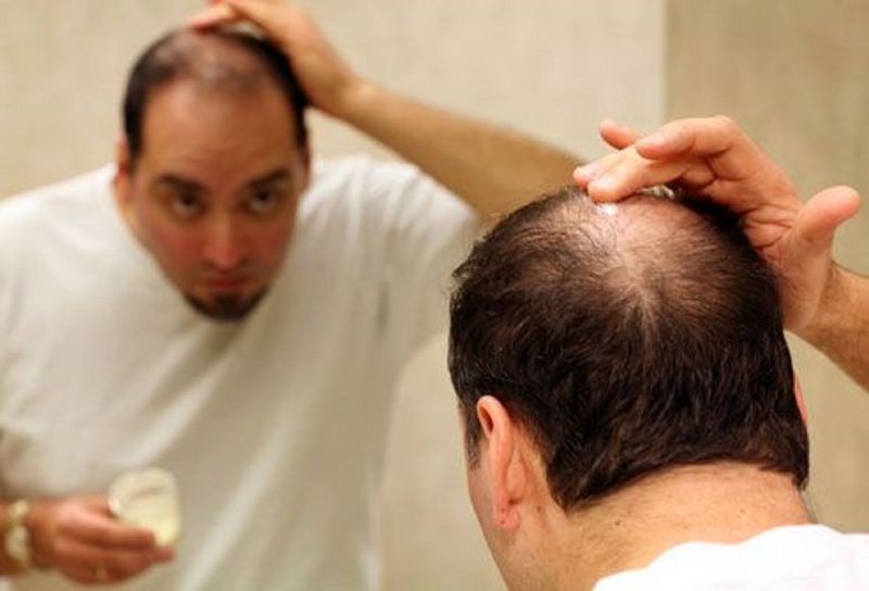 Psychological Effects of Hair Loss