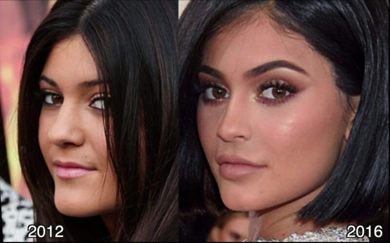 Kylie Jenner Before and After Nose Job