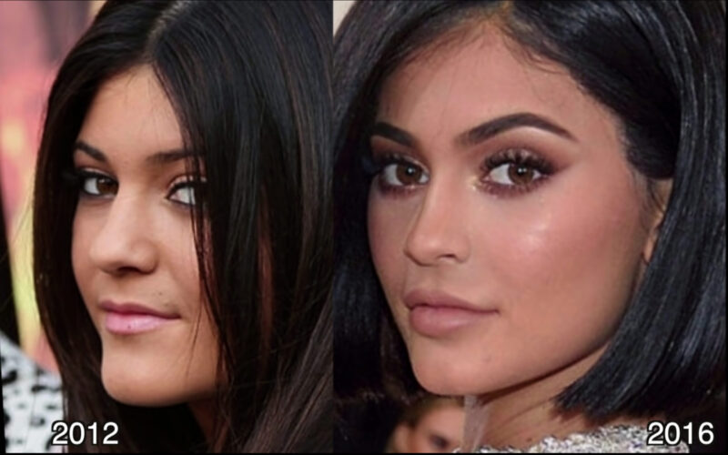 kylie jenner before surgery Kylie Jenner Before and After Nose Job