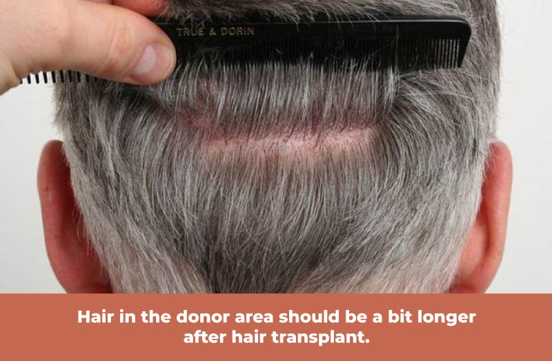 Hair in the donor area should be a bit longer after hair transplant