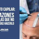 Injerto capilar 5 razones