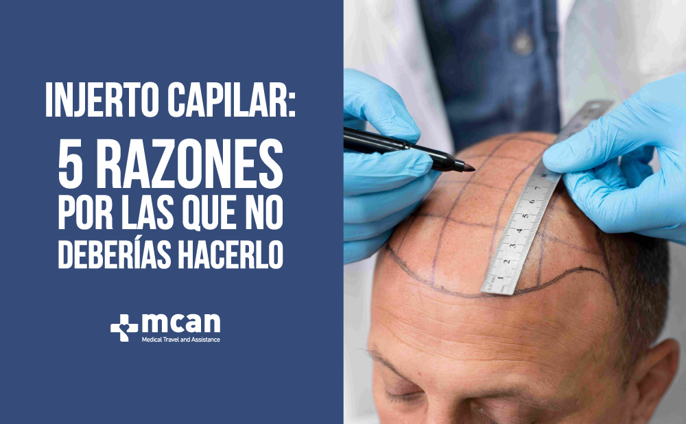 Injerto capilar 5 razones