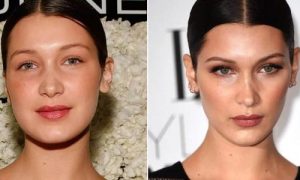 bella hadid nose job