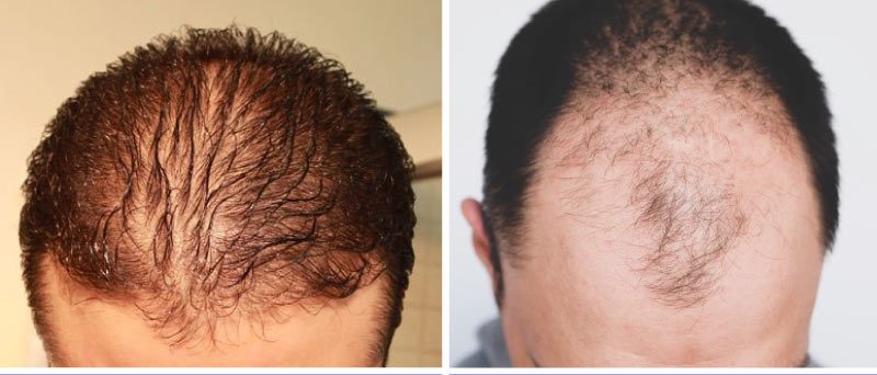 Diffuser Haarausfall vs. Haarausfall bei Männern Arten von Haarausfall