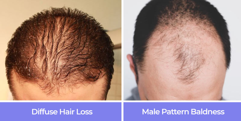 Diffuse hair loss vs male pattern baldness