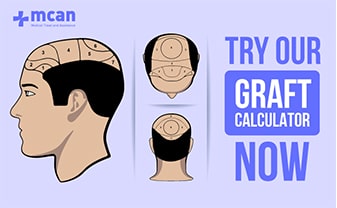 graft calculator for hair transplant blog