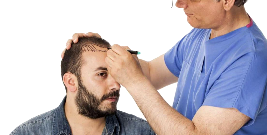 hair transplant banner