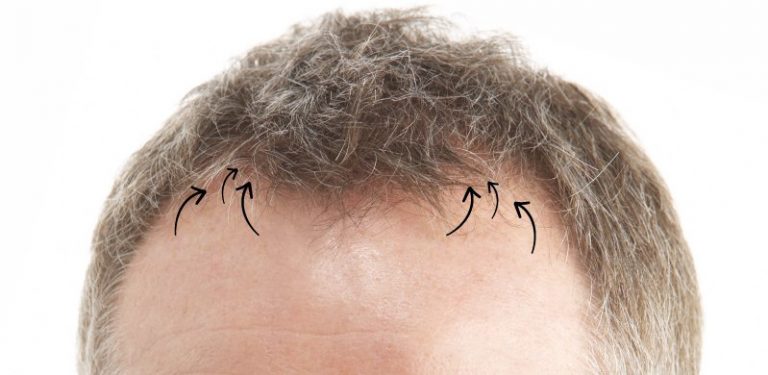 The male pattern hair loss has a pattern equally receding on both sides