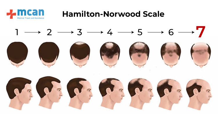 Norwood 7 hair transplant