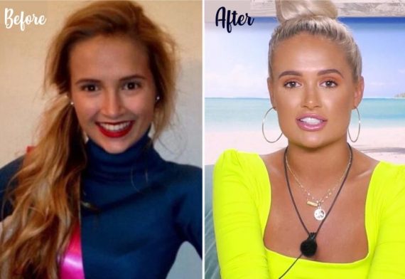 Plastic Surgery in Love Island: A Close Up To Islanders - Hair
