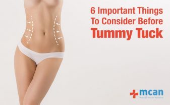 six things to consider before tummy tuck blog